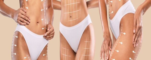 Liposuction ile İstenmeyen Yağlarınızdan Kurtulun