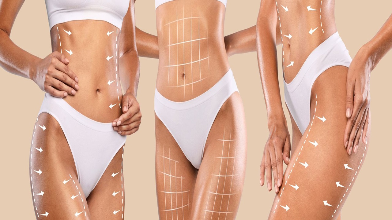 Liposuction ile İstenmeyen Yağlarınızdan Kurtulun